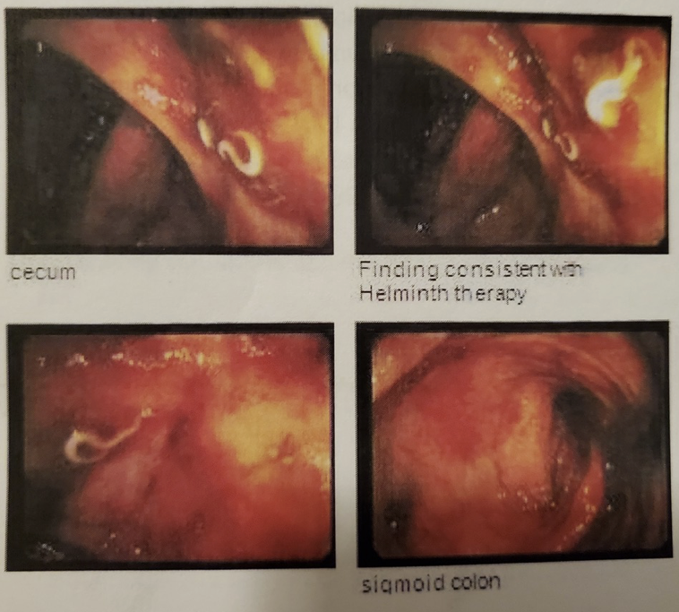 Ace Wilkins' colon at 7½ years with NA and TTO.png