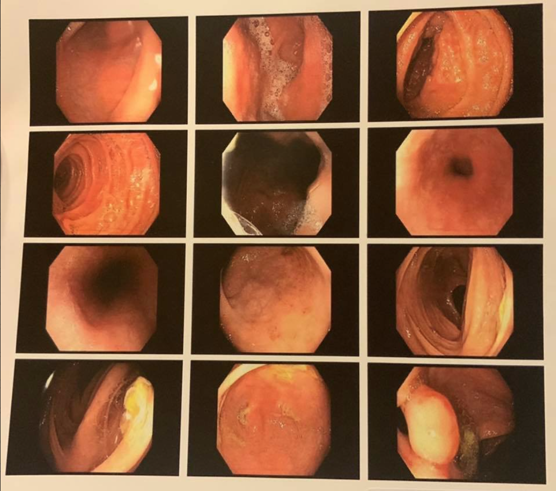 Colonoscopy images of a Crohn’s colitis patient after 5 years with NA and TTO.png