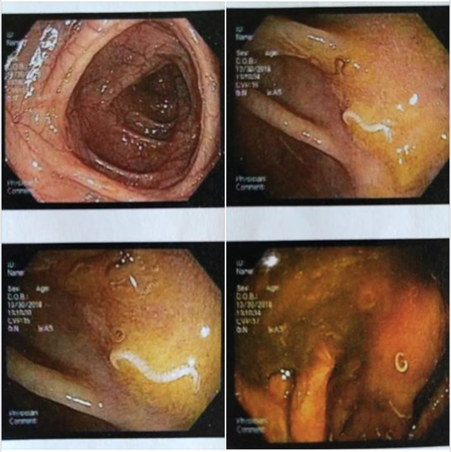 Colonoscopy images of a colitis patient after 5½ years with NA and TTO.png